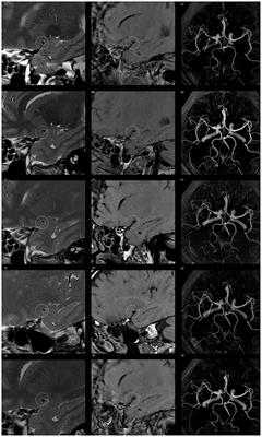 Standard-Dose Atorvastatin Treatment in Patients With Symptomatic Middle Cerebral Artery Atherosclerotic Stenosis: A Vessel Wall Magnetic Resonance Imaging Study